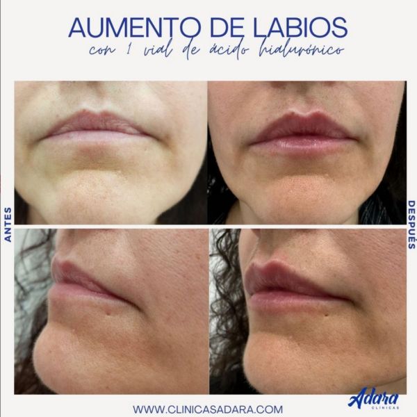 Relleno con &aacute;cido hialur&oacute;nico. Aumento de labios