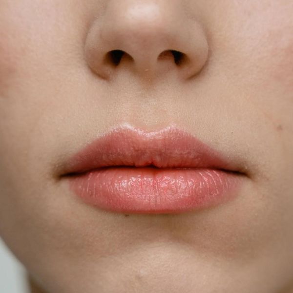 El aumento de labios en Valladolid Clínicas ADARA