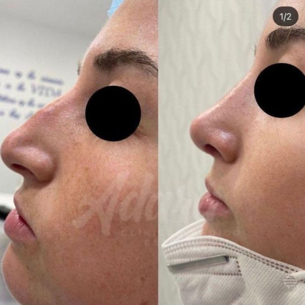 Rinoplastia ultrasónica