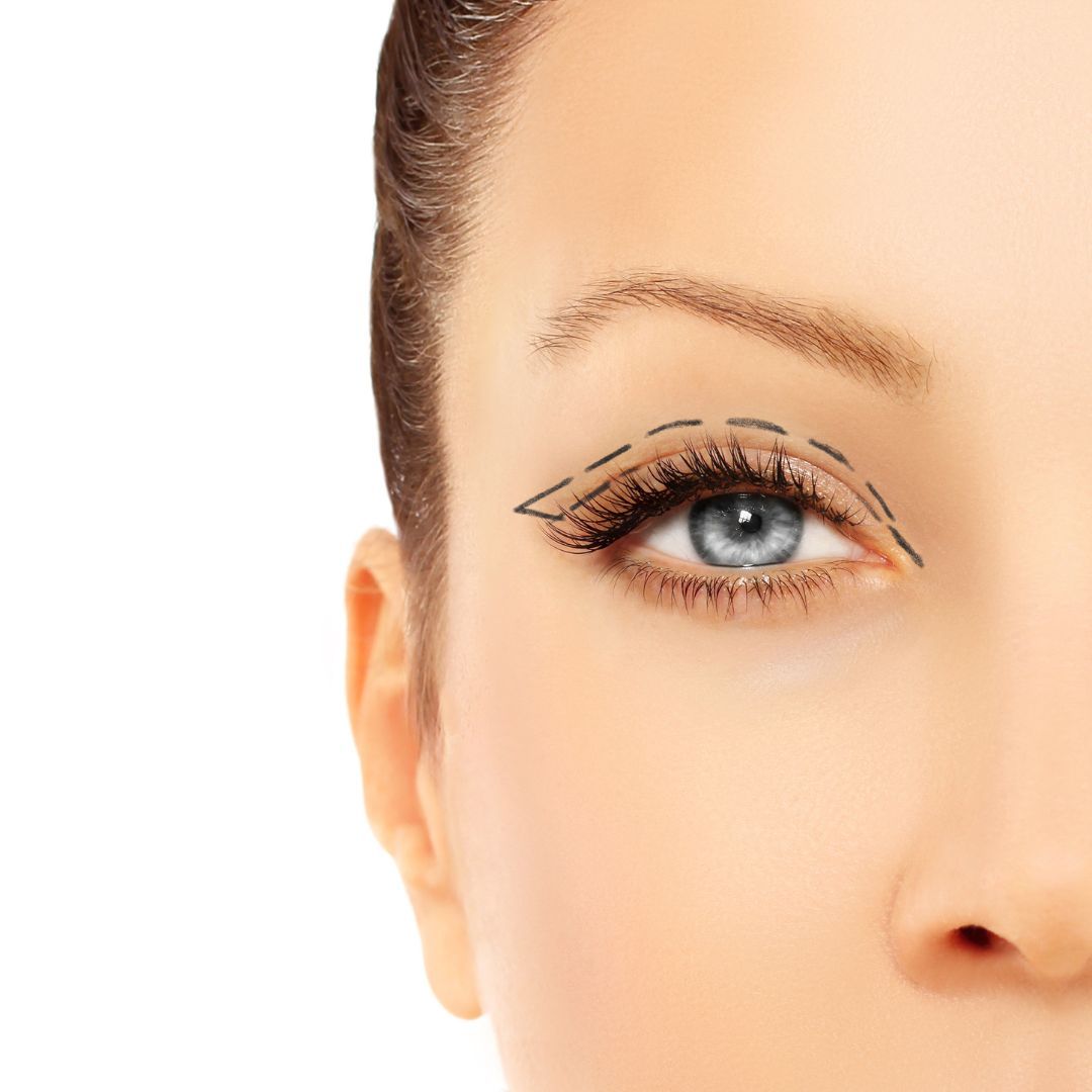 Blefaroplastia medicina estética en Valladolid