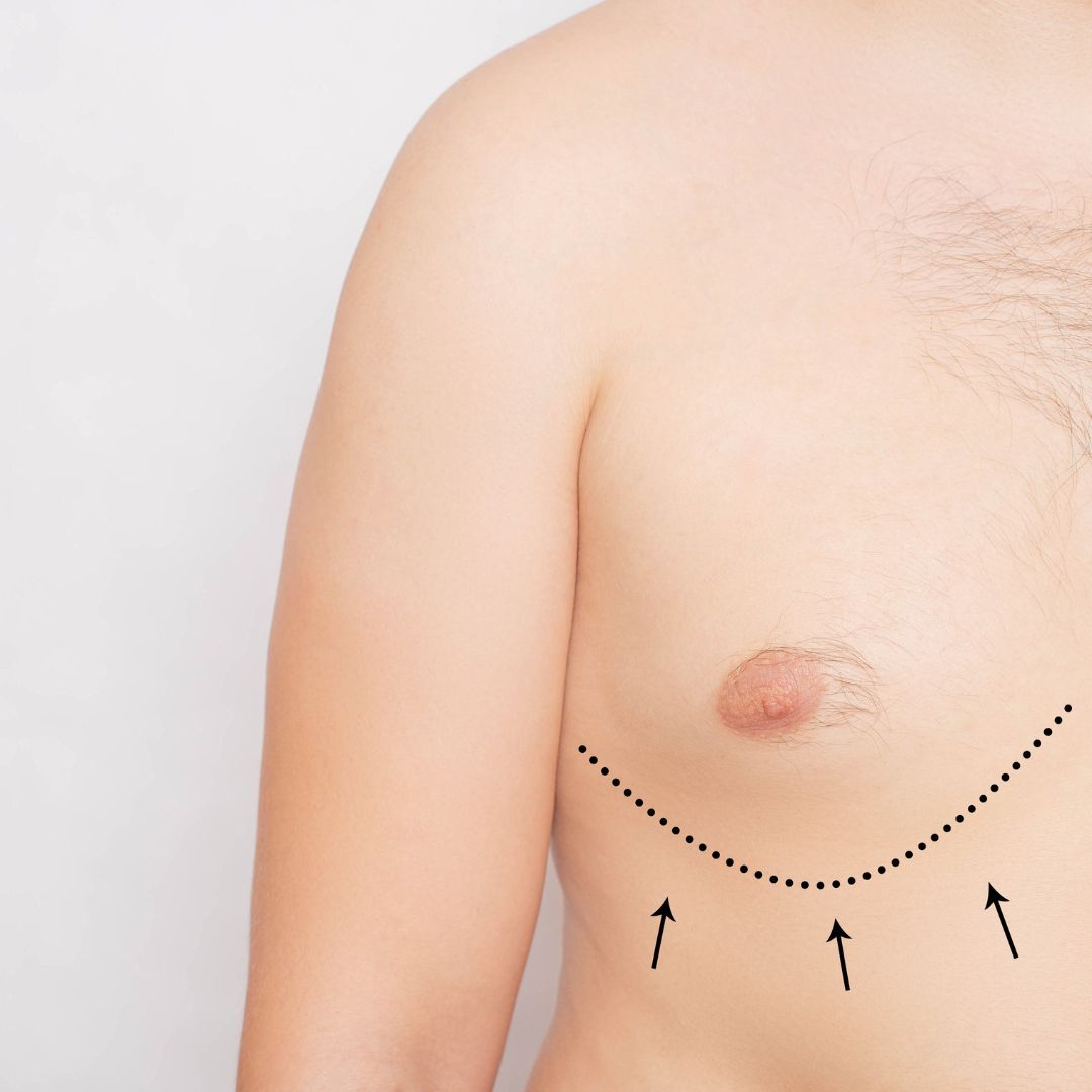 Ginecomastia medicina estética en Valladolid