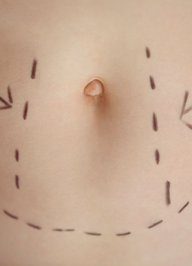 Cirugía bariátrica en Valladolid Clínicas Adara